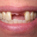 Before I had my Mini Dental Implants