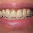 My old partial denture with my two front teeth on it