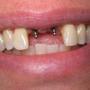 Mini Dental Implant the day of placement