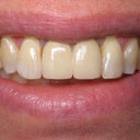 My Porcelain crowns on the mini dental implants