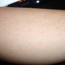 Lower leg after first laser treatment with Alexandrite 755nm laser for hair reduction/removal. One week post first treatment.