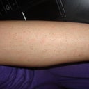 Lower leg and most of the hairs are ingrown unfortunately...