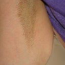 Underarm post 1 week after treatment with laser.