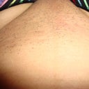 Bikini post 1 week of laser hair removal first treatment.