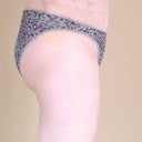 8 days post op side-still a bit  swollen