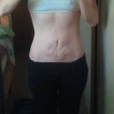 After over year later. Wrinkles are due to strectch marks from 2 pregnancies not procedure.