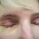 3 Days After Surgery