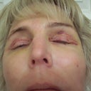 5 Days After Surgery 