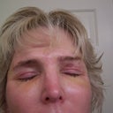 10 Days After Surgery
