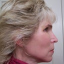 10 Days After Surgery
