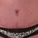 Close up of my BB and incision, healing a lot better than I thought it would!