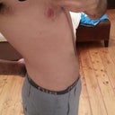 Post Op - 9 weeks