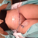 Post op day 5. This was at my drs appt.