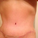 TT 1/31, finally very little swelling!