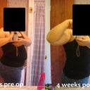 4 weeks post op with before
Im Extremely Pleased with what I see