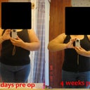 4 weeks post op with before
Im Extremely Pleased with what I see