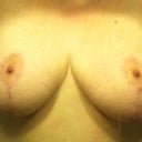 9 months post op