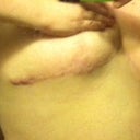 side scars - 9 months post op