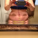 my verticle scar