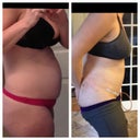 Before vs. a few days post op