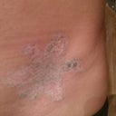 2 weeks after 13th treatment
