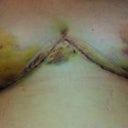 Day 5 Incisions