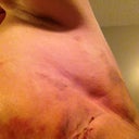 Lipo Ouchies