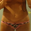 close up...scar is healing see the uneven sides?