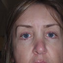 18 months post surgery, not really happy with results.  Definitely drooping in lower lids.  Will consider future surgery to improve.