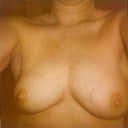 Prior to mastectomy but post lumpectomies, other than size difference which I'd not noticed until photo, I was thrilled with my breasts, however the lumpectomies were starting to take their toll, leaving pits of emptiness.