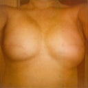 This was the expanders just before changing out to implants cleavage not as bad as now and doctor has said he'd address the size height issue and try to give more cleavage.