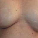 7 yrs post op