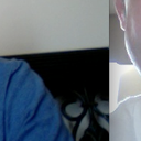Both post-op...but the first shows REALLY swollen...2nd shows swollen only on one side. It goes down!