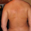 15 Days post OP