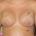 This is two weeks post op, the bruising is all but gone now.  Will be taking more pics this weekend!