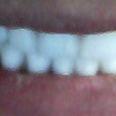 Temp teeth. I walked out with these that afternoon