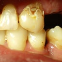 Original teeth- Broken, decayed and missing. I walked in with these in that morning