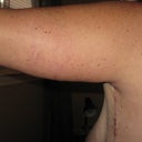 Post Op back view
