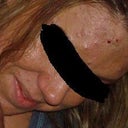Before Accutane