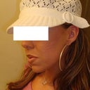 After Accutane