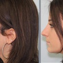 Here is the digital image that my doctor sent me. I don't really like how big my nostrils are and how long the nose still is. I hope my result will be different. However, it's a huge improvement!