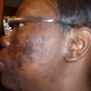 one day later no peelin just scarring(left side)