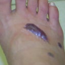 Blood blister from 2nd session.