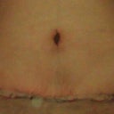 Post op day 3, I have 2 drains that are about 2in below my incision
