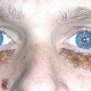 6 days after the surgery