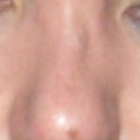 skin heal over-stick nose bone