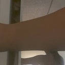 pre-op (never ended up getting my arms done)