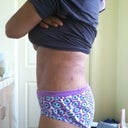 Post Op Day 12 Left Side