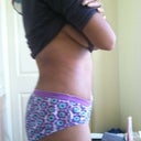Post Op Day 12 Right Side