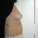 Side view of the right breast that sunk in after explant. This is after 5 days of brava wear.